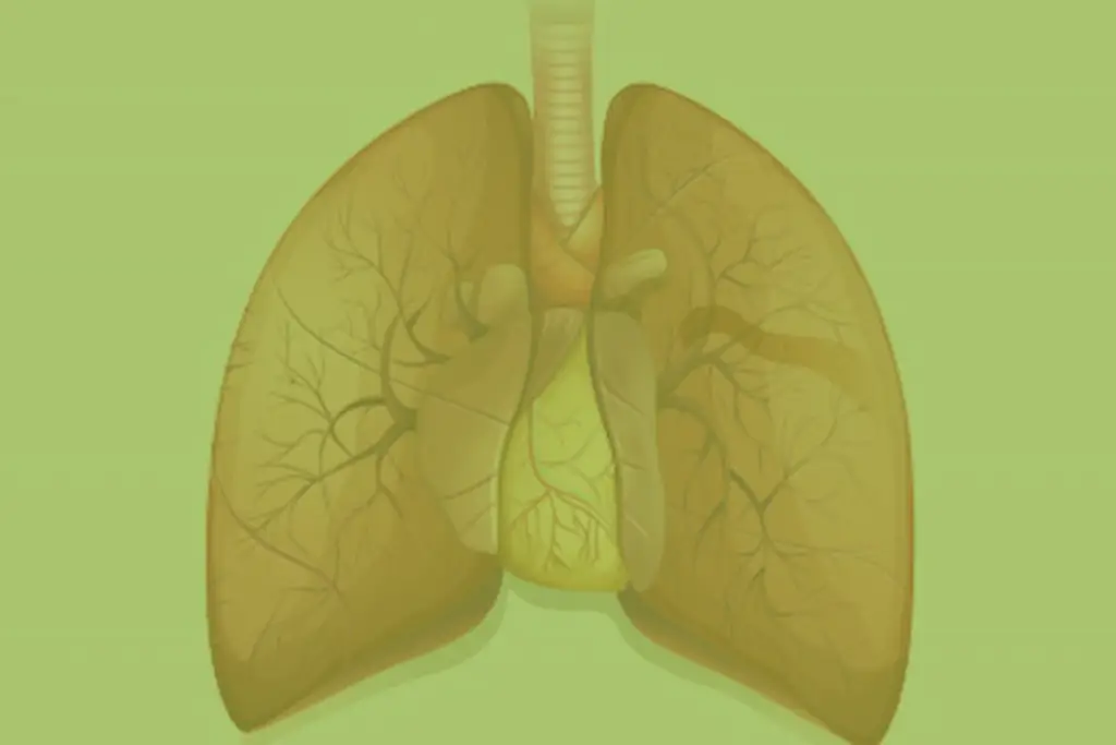 Acute Severe Asthma