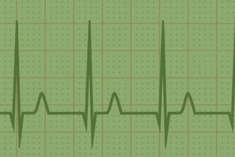 decoding ECG